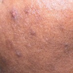 Papules