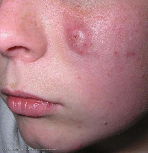 cystic-acne-causes-symptoms-and-treatments