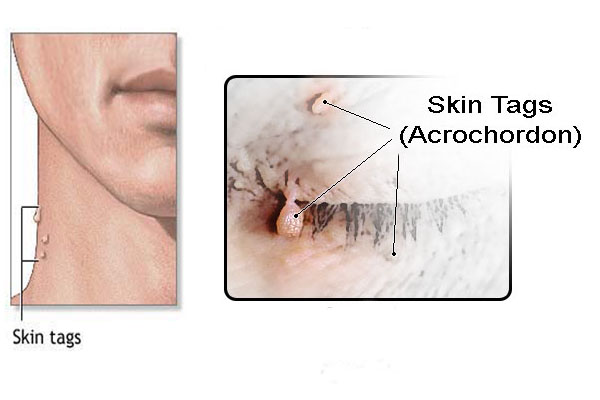 Skin tags. Acrochordons